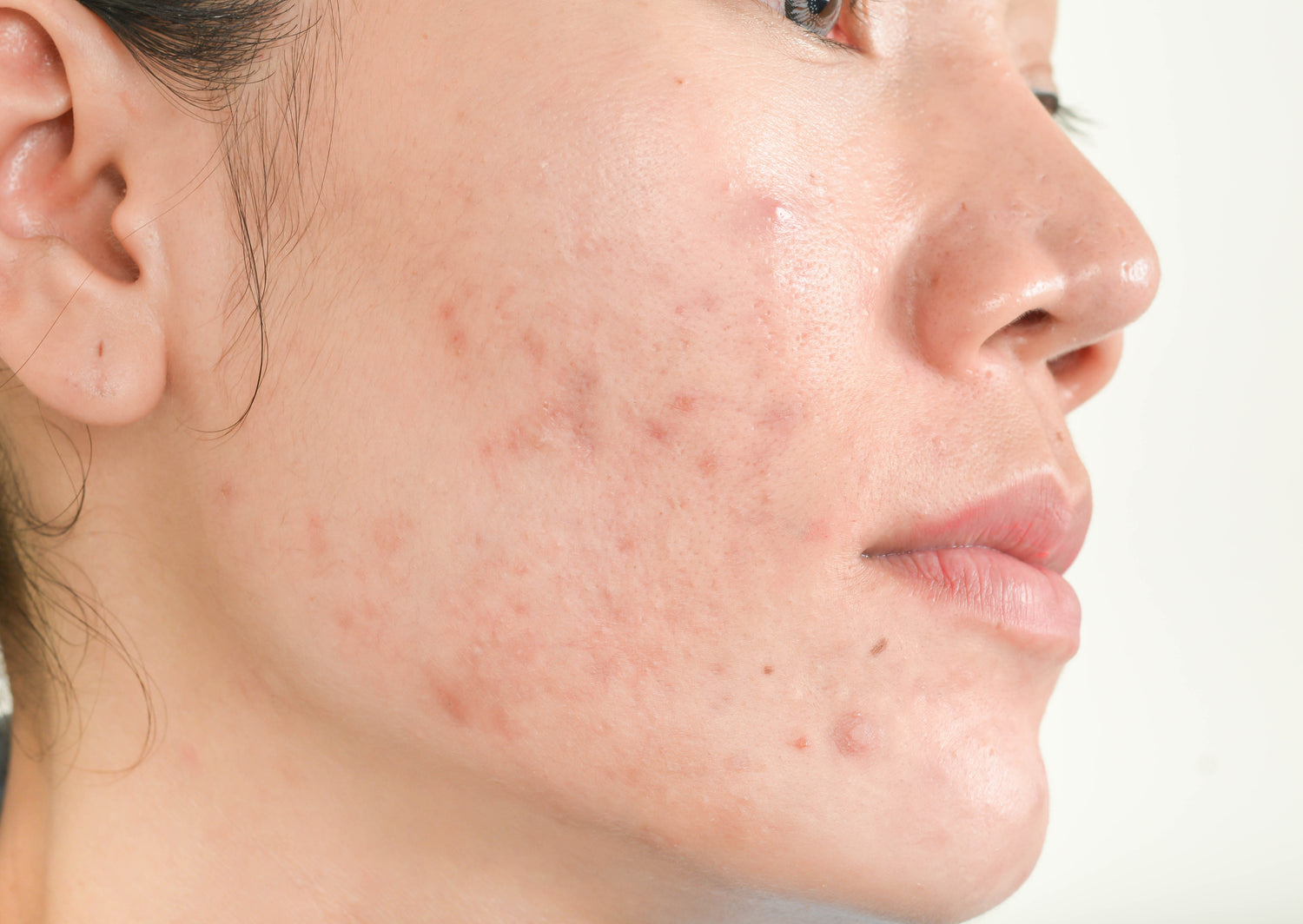 Acne Scars: Understanding and Treating Varied Types